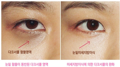[두한성형외과 다크서클] - [다크서클 콜펫지방이식] 관련 이미지 17