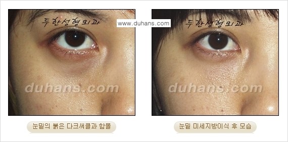 [두한성형외과 경쟁력 미세지방이식] - [다크써클 & 눈밑주름 미세지방이식 4.] 관련 이미지 10