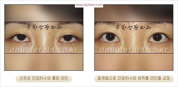 [두한성형외과 경쟁력 눈성형] - [극한 재수술, 함몰된 눈꺼풀 라인교정, 안검하수(졸리운 눈매)] 관련 이미지 102