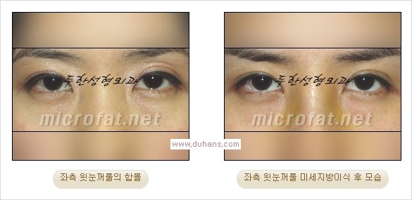 [두한성형외과 경쟁력 쌍꺼풀 재수술, 극한 눈재수술] - [어색한 쌍꺼풀 라인을 교정하는 윗눈꺼풀 미세지방이식] 관련 이미지 12