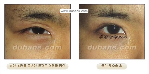 [두한성형외과 경쟁력 눈성형] - [두꺼운 라인을 교정하는 극한 눈 재수술 2.] 관련 이미지 2