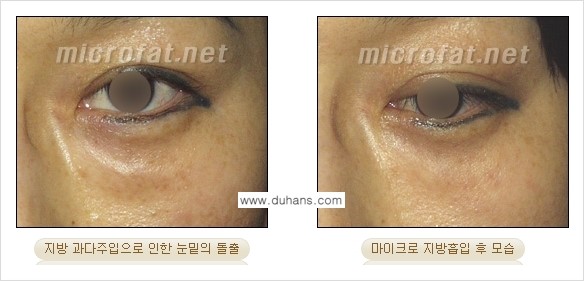 [두한성형외과 경쟁력 미세지방이식] - [미세지방이식 부작용 종류와 교정방법 안내] 관련 이미지 12