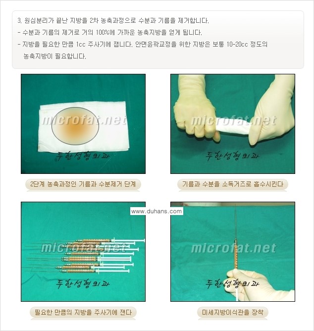 [두한성형외과 "미세지방이식"] - [지방이식 부작용 교정 정보 ②] 관련 이미지 8