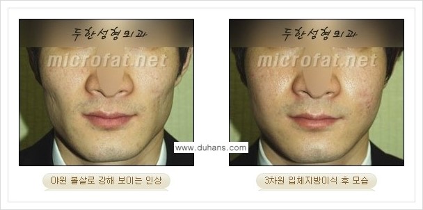 [두한성형외과 경쟁력 볼살지방이식] - [사각턱의 경우, 측면 볼살의 함몰선, 안면비대칭, 남성 야윈볼살 안내] 관련 이미지 15