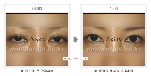 [두한성형외과 경쟁력 쌍꺼풀 재수술, 극한 눈재수술] - [망친 쌍꺼풀, 망가진 쌍꺼풀 복원수술, 재수술의 성공요건] 관련 이미지 10