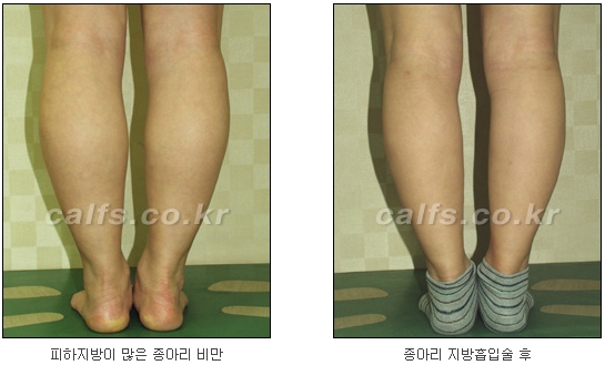 두한성형외과 지방흡입 - 부위별 안전 지방흡입 관련 이미지 33