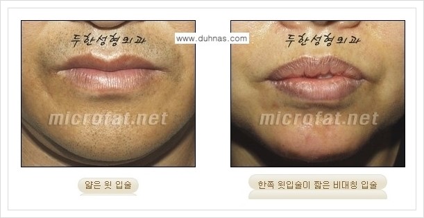 [두한성형외과 경쟁력 미세지방이식] - [입술 미세지방이식 안내 1.] 관련 이미지 2