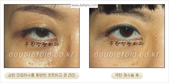 [두한성형외과 경쟁력 눈성형] - [극한 재수술, 함몰된 눈꺼풀 라인교정, 안검하수(졸리운 눈매)] 관련 이미지 23