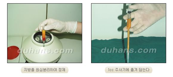 ✨눈 위 꺼짐, 단순 미용이 아닌 기능까지 고려해야 하는 이유✨ 관련 이미지 5