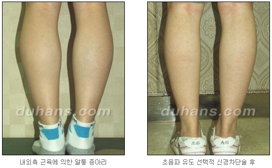 [Duhan Plastic Surgery Calf Reduction] - [How to Get Rid of Calf Muscle Bulges] image 24