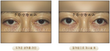 [두한성형외과 쌍커풀재수술] - [심한 소세지눈, 두줄따기, 쌍꺼풀 흉터] 관련 이미지 20