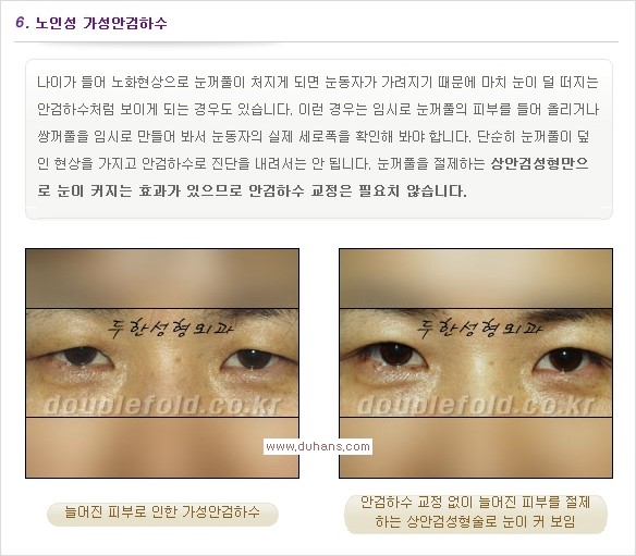 [두한성형외과 경쟁력 쌍꺼풀 재수술, 극한 눈재수술] - [안검하수 종류 안내] 관련 이미지 9