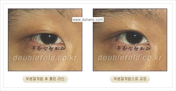 [두한성형외과 경쟁력 쌍꺼풀 재수술, 극한 눈재수술] - [풀린 쌍꺼풀 라인 교정수술 안내] 관련 이미지 9