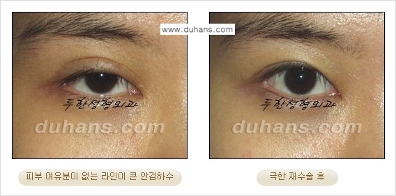 [두한성형외과 경쟁력 눈성형] - [두꺼운 라인을 교정하는 극한 눈 재수술 2.] 관련 이미지 7