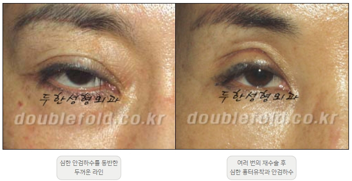 [Double Eyelid Surgery, Duhan Plastic Surgery] - [Extreme Revision Eye Surgery to Correct a Damaged Line] image 3