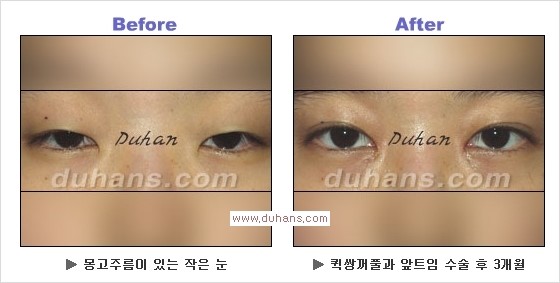 ​[두한성형외과 경쟁력 눈성형] - [자연스러운면서 매력적인 쌍꺼풀 퀵 쌍꺼풀 수술 안내] 관련 이미지 15