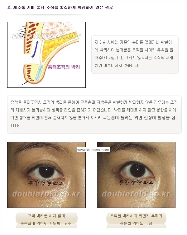 [두한성형외과 경쟁력 쌍꺼풀 재수술(눈재수술)] - [쌍꺼풀 재수술(눈재수술)의 실패의 원인 분석] 관련 이미지 3