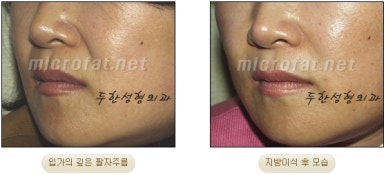 [Duhan Plastic Surgery Face Fat Grafting] - [Reducing Mouth Corners Wrinkles and Nasolabial Folds] image 10