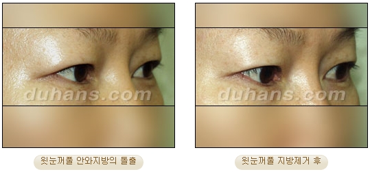 두한성형외과 지방제거 - 눈밑지방, 눈꺼풀지방제거 관련 이미지 11