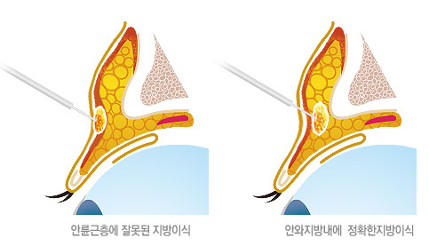 [눈밑수술 두한성형외과] - [다크서클 콤비프로그램] 관련 이미지 44
