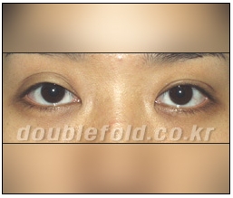 [Duhan Plastic Surgery Double Eyelid Revision Surgery] - [Ptosis Correction Surgery] image 7