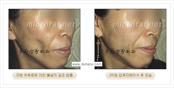 [두한성형외과 경쟁력 윤곽성형] - [볼, 볼살 지방이식] 관련 이미지 21