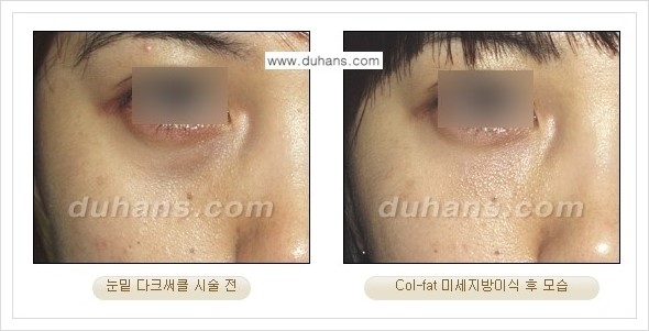 [두한성형외과 경쟁력 미세지방이식] - [지방이식 특허 Col-fat 미세지방이식 성공사례 안내] 관련 이미지 4