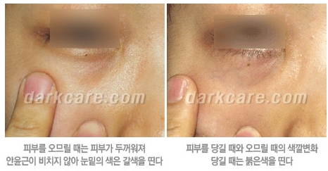 Duhan Plastic Surgery Dark Circle Improvement - What Causes Dark Circles? What Types of Dark Circles Are There? image 4