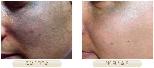 Duhan Plastic Surgery Laser Treatment - Mole Removal, Spot Removal, Melasma, Blemishes, Hyperpigmentation, Skin Tone Improvement, Elasticity Improvement, Skin Texture Improvement image 24