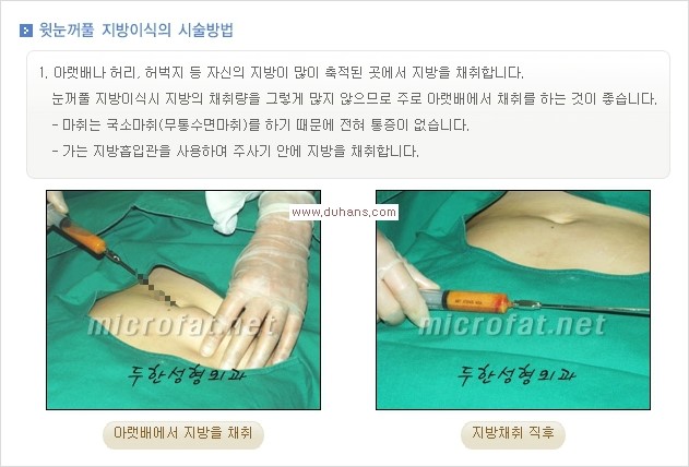 [두한성형외과 경쟁력 쌍꺼풀 재수술, 극한 눈재수술] - [어색한 쌍꺼풀 라인을 교정하는 윗눈꺼풀 미세지방이식] 관련 이미지 2