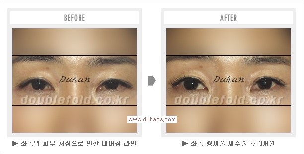 [두한성형외과 쌍꺼풀 재수술, 극한 눈재수술] - [재수술에 대한 자주하는 질문과 답변 안내] 관련 이미지 7