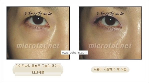[두한성형외과 경쟁력 눈밑성형] - [눈밑지방제거, 눈위지방제거 안내 1.] 관련 이미지 23