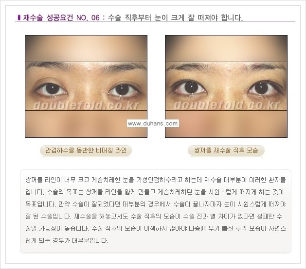 [두한성형외과 경쟁력 쌍꺼풀 재수술, 극한 눈재수술] - [망가진 쌍꺼풀 재수술의 성공요건 안내] 관련 이미지 7