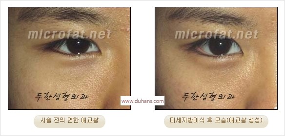 [두한성형외과 경쟁력 미세지방이식] - [애교살 필러 시술의 부작용 교정] 관련 이미지 14