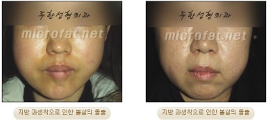 [두한성형외과 지방이식] - [타병원의 지방이식 부작용 교정] 관련 이미지 1