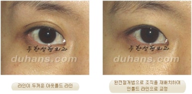 Best Place for Revision Eyelid Surgery, Duhan Plastic Surgery - Lowering Double Eyelid Line image 17