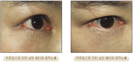 [Duhan Plastic Surgery Double Eyelid Revision] - [Inner Corner Revision, Outer Corner Revision] image 14