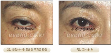 Duhan Plastic Surgery Ophthalmic Reoperation - What Is a Successful Double Eyelid Revision Surgery? image 9