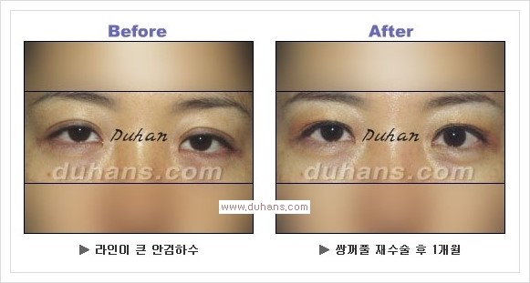 [두한성형외과 경쟁력 눈성형] - [안검하수(졸리운 눈매)의 종류와 교정 방법 안내] 관련 이미지 11