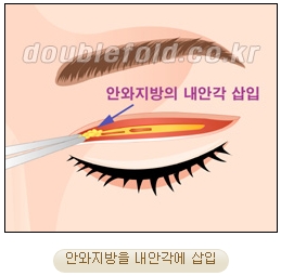 [두한성형외과 쌍커풀재수술] - [심한 소세지눈, 두줄따기, 쌍꺼풀 흉터] 관련 이미지 13