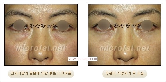 ⁠⁠[두한성형외과 경쟁력 안검성형] - [젊은 눈매를 위한 윗눈꺼풀 지방제거, 눈밑 지방제거] 관련 이미지 24