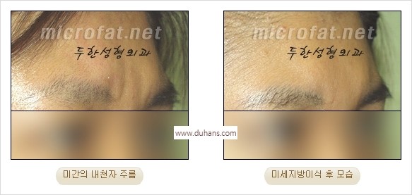 [두한성형외과 경쟁력 동안성형 리더] - ​[미간주름, 이마주름, 안검성형, 이마거상술, 눈썹거상술] 관련 이미지 11