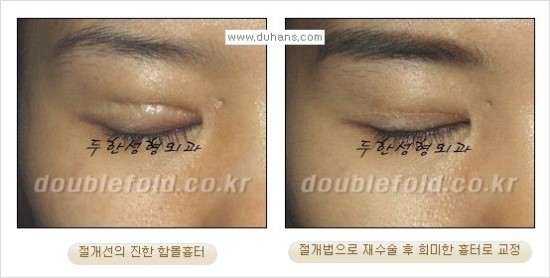 [두한성형외과 경쟁력 눈성형] - [쌍꺼풀 재수술 대상과 재수술의 문제점, 미운쌍꺼풀, 재수술 방법들] 관련 이미지 81