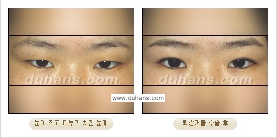 [두한성형외과 경쟁력 눈성형]- [최소 부기로 일상의로의 복귀가 가능한 아름다운 퀵쌍꺼풀(부분절개법) 수술] 관련 이미지 15