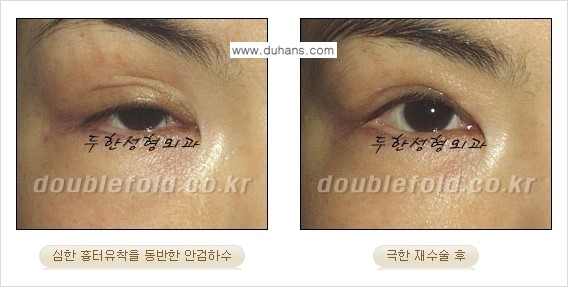 [두한성형외과 경쟁력 쌍꺼풀 재수술, 극한 눈재수술] - [망친 쌍꺼풀을 복원하는 극한 눈재수술] 관련 이미지 12