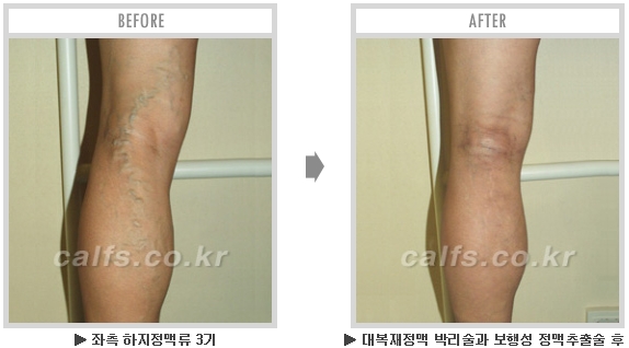 [종아리성형 두한성형외과] - [종아리수술에 대한 자주하는 질문과 답변 모음] 관련 이미지 9