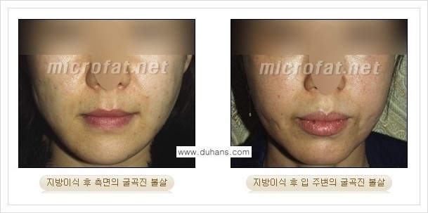 ⁠[두한성형외과 경쟁력 미세지방이식] - [미세지방이식의 부작용 문제 교정 안내] 관련 이미지 11
