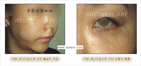 [두한성형외과] - [제대로 된 지방이식으로 부작용에서 탈출하자!] 관련 이미지 8