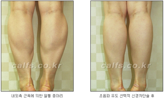 [두한성형외과 종아리퇴축술] - [NO절개! 초음파유도신경차단술] 관련 이미지 24