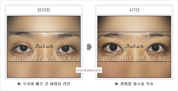 [두한성형외과 경쟁력 눈성형] - [나에게 맞는 어울리는 쌍꺼풀 라인] 관련 이미지 48